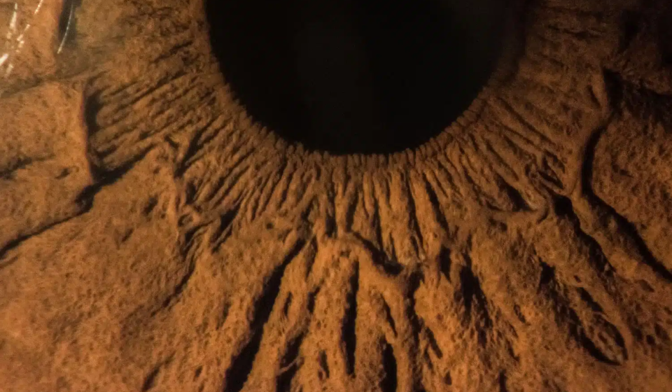 glaucoma (Copiar)