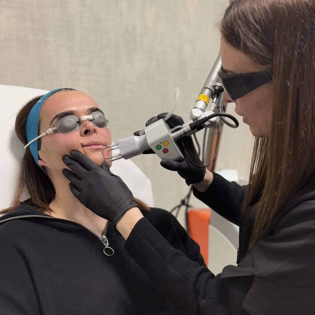 CoolPeel laser co2