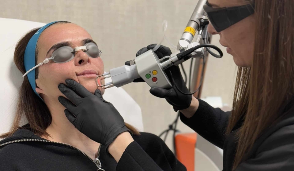 CoolPeel láser co2