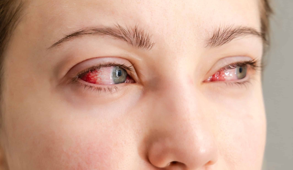 Close up of the red irritated human eyes, allergy symptom, conjunctivitis