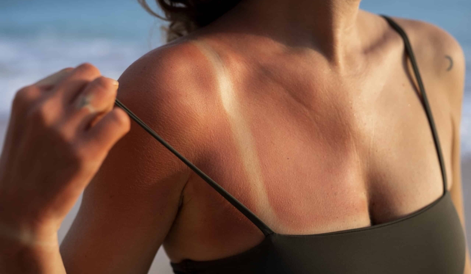 details-woman-s-sunburn-skin-from-beach-sun