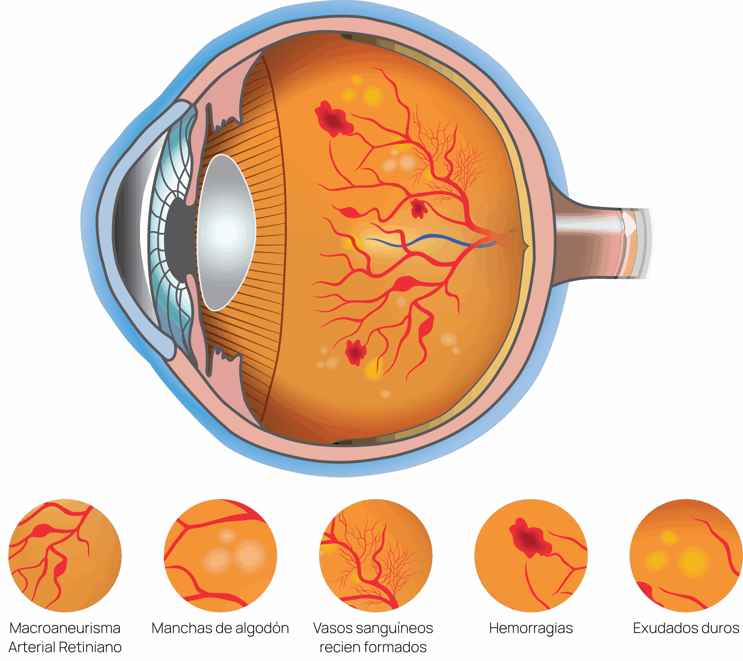 Retinopatía Diabética 18 retinopatia diabetica scaled