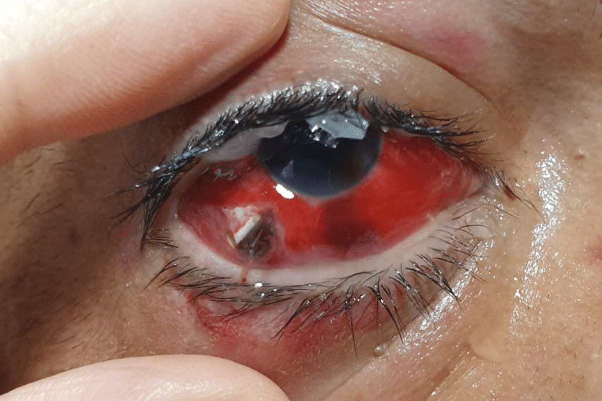 traumatismo ocular 1