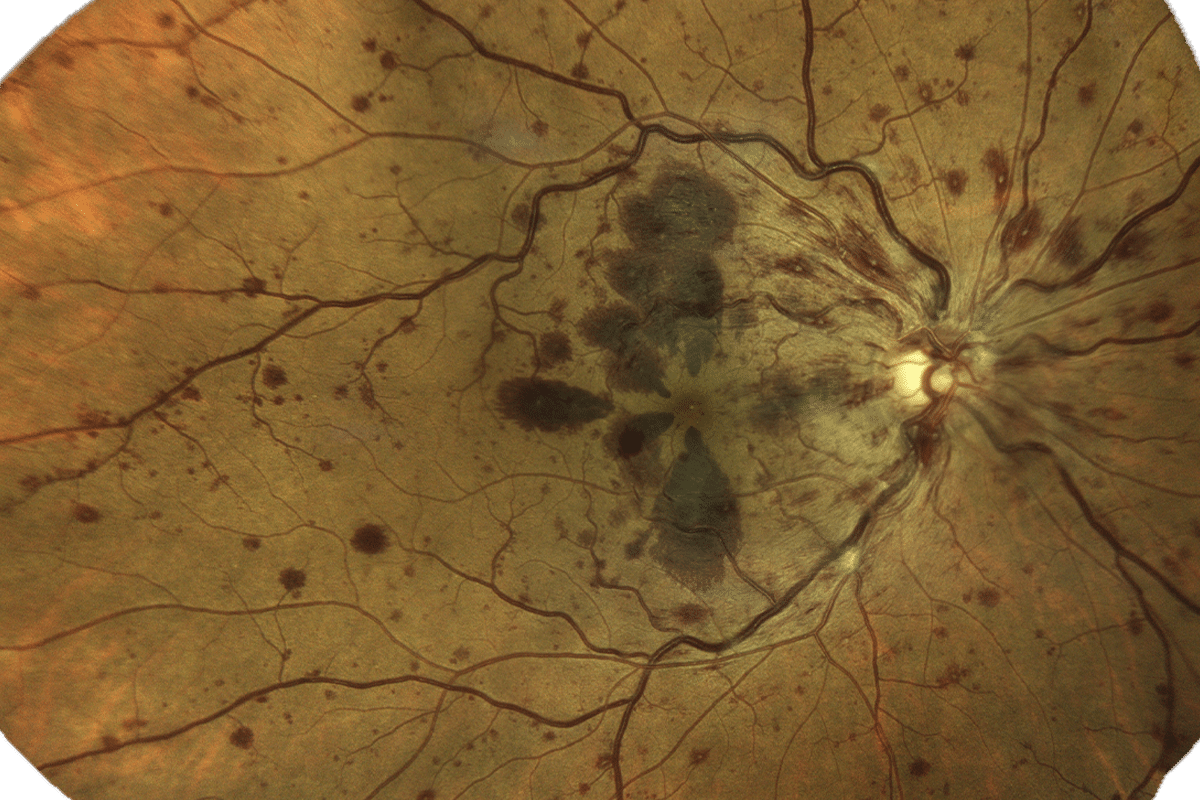 trombosis retina