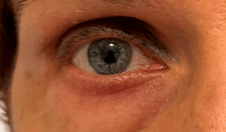 blefaroplastia-noquirurgica