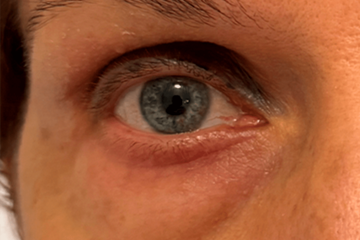 blefaroplastia noquirurgica