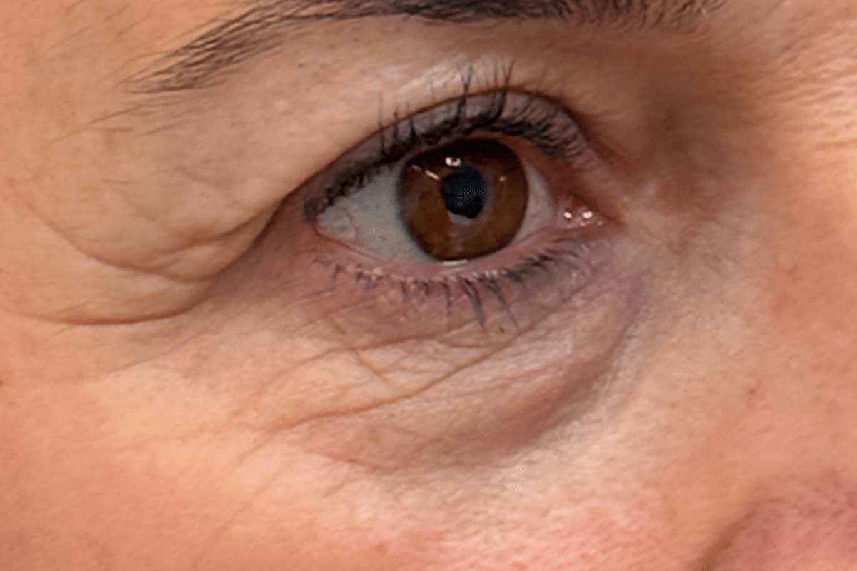 blefaroplastiainferior 1