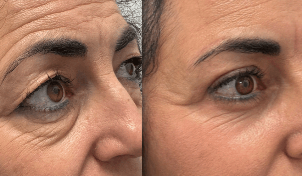 Blefaroplastia