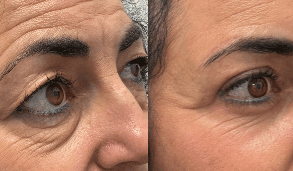Lifting de Cejas