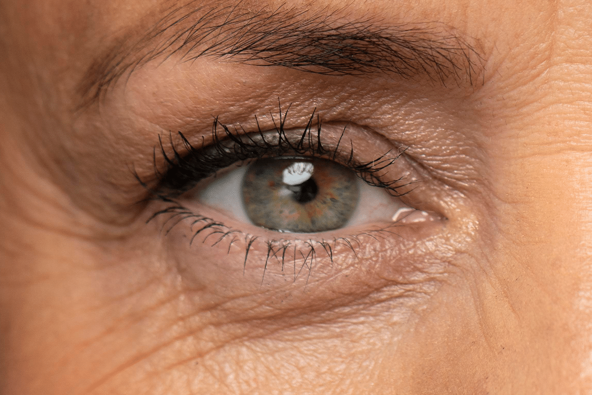 ptosis palpebral