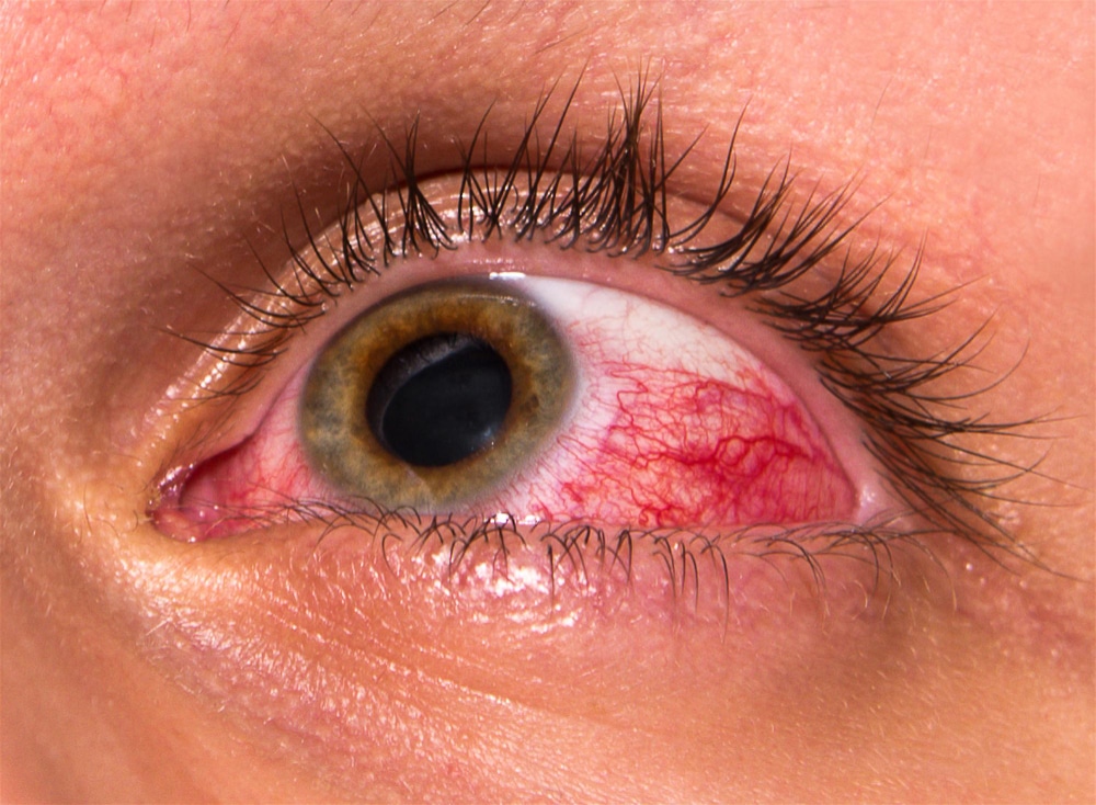 uveitis