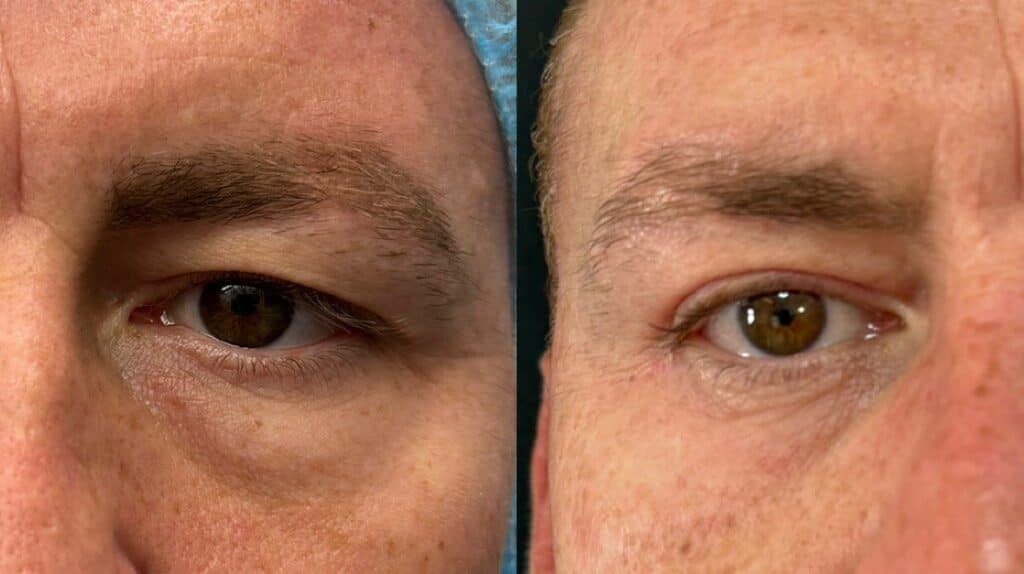 Blefaroplastia Masculina