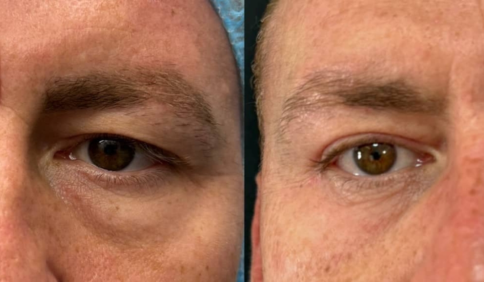 blefaroplastiamasculina