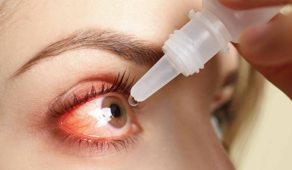 Closeup view of woman with inflamed eyes using drops